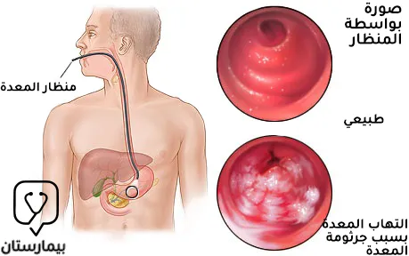 صورة بتنظير المعدة توضح التهاب المعدة الناتج عن جرثومة المعدة