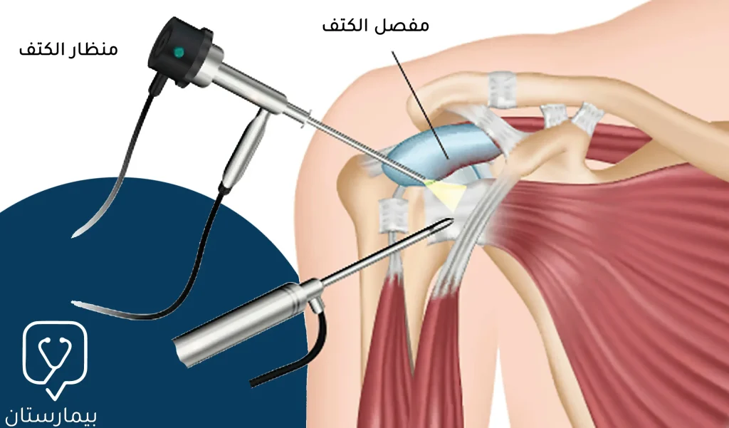 كيفية إجرا عملية خلع الكتف بالمنظار