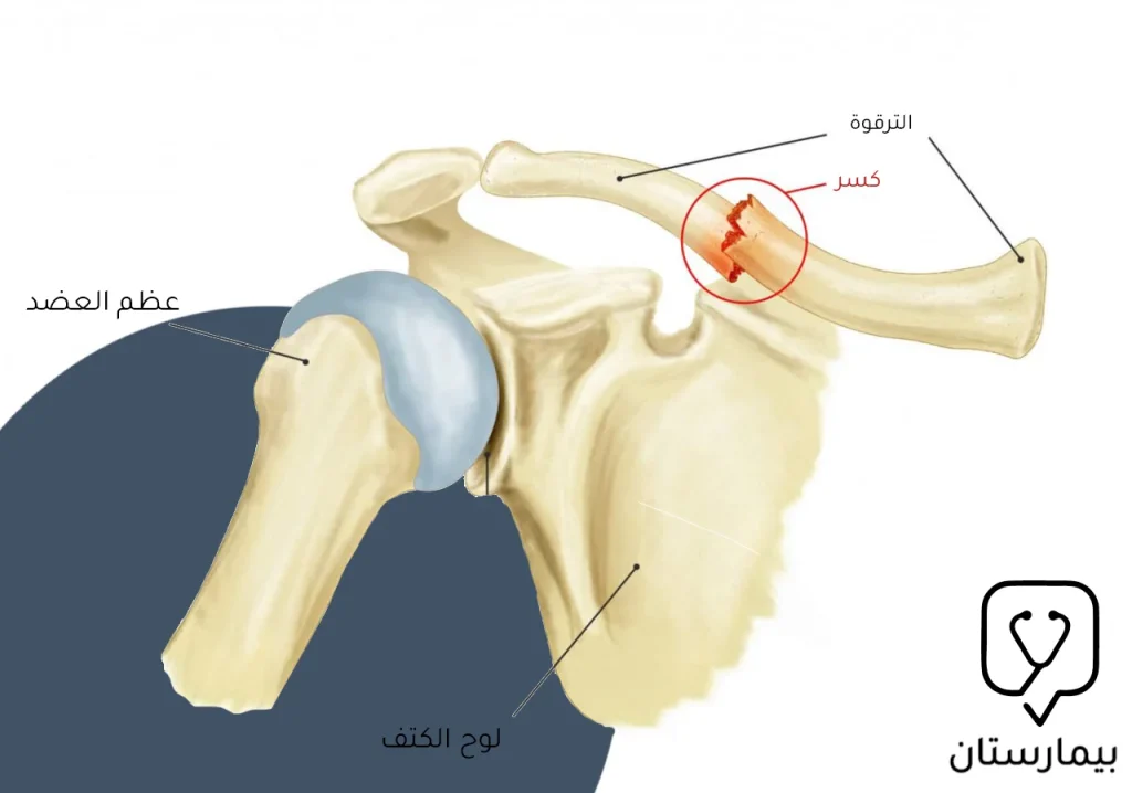 صورة لكسر في عظم الترقوة والذي يعد من أشيع أنواع كسر الكتف