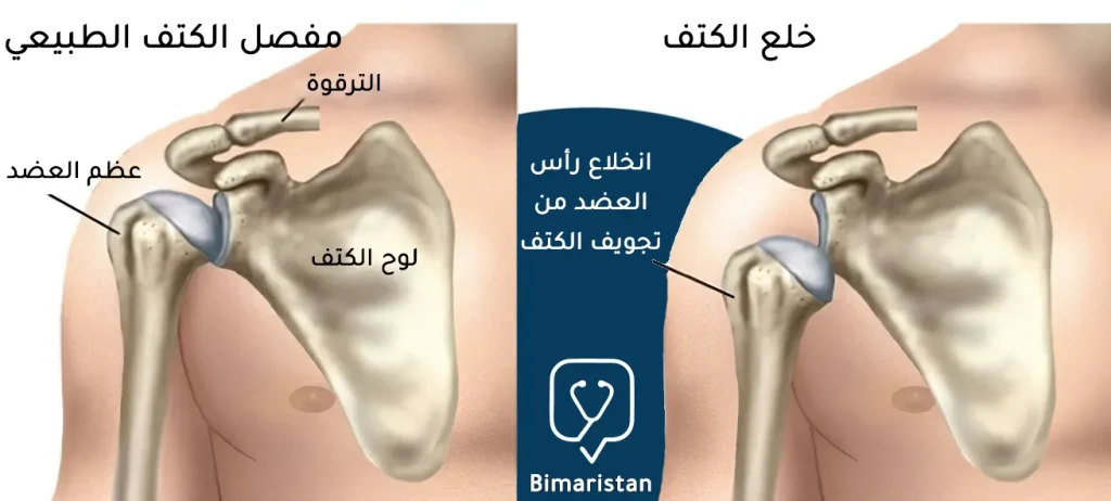 توضح هذه الصورة مقارنة بين مفصل الكتف الطبيعي وحالة خلع الكتف