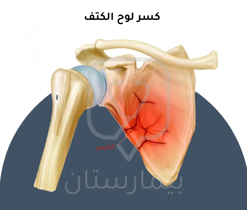 صورة توضحية لأحد الأنواع النادرة من كسر الكتف وهو شرخ عظم لوح الكتف 