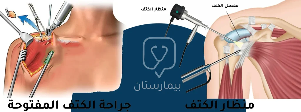 توضح هذه الصورة الفرق بين عملية خلع الكتف بالمنظار وبين الجراحة المفتوحة