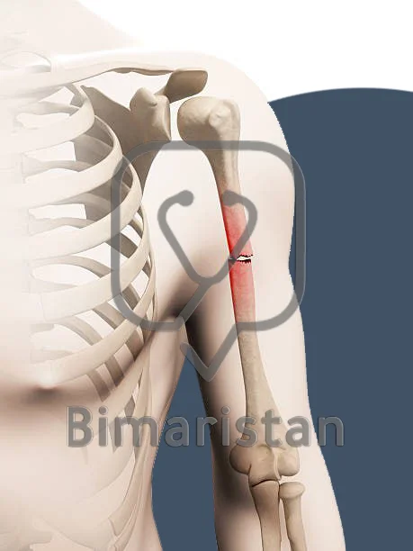 نلاحظ في هذه الصورة وجود كسر في منتصف عظم العضد وهو يعتبر أحد انواع كسر الكتف والذراع