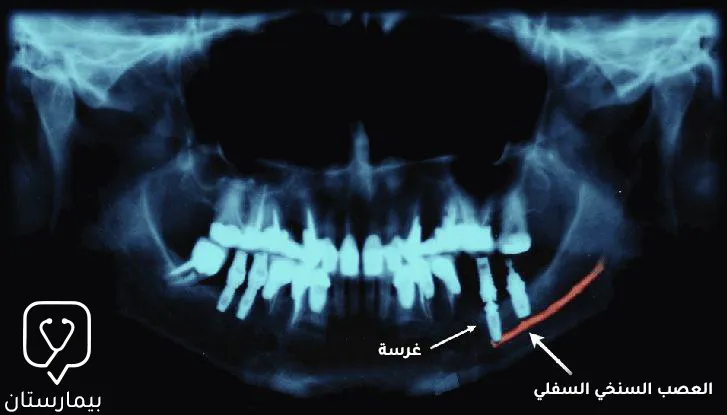 نلاحظ في الصورة قرب الغرسة الشديد من العصب السنخي السفلي و الذي يسبب أذية للعصب