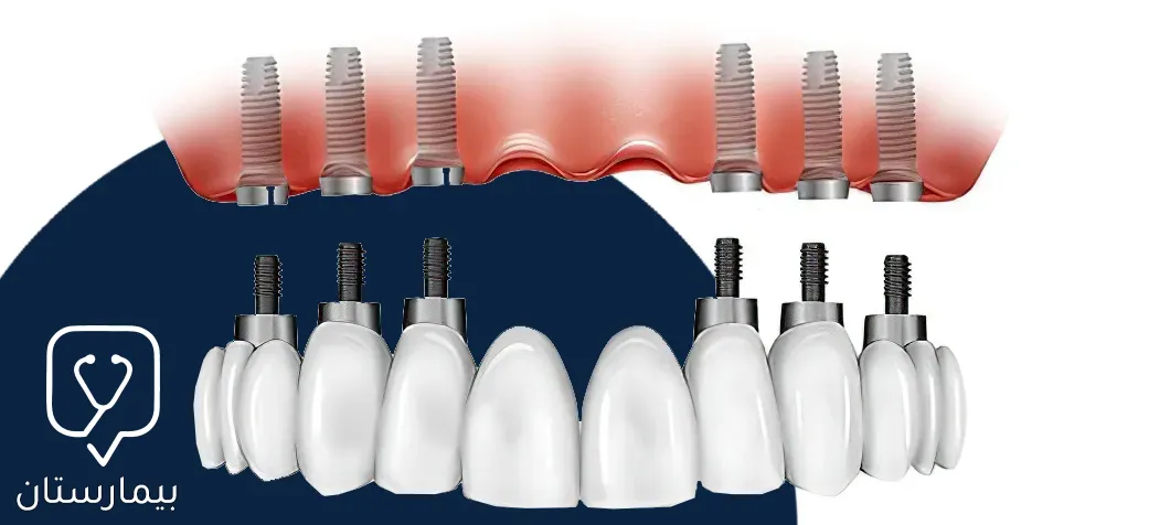 نلاحظ في الصورة توضع الغرسات السنية بتقنية All On 6 والجسر الثابت فوقها