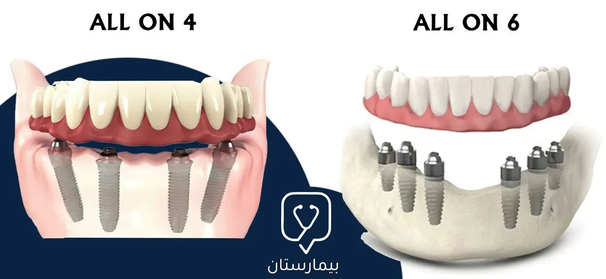 نلاحظ في الصورة الفرق بين توضع الغرسات في كل من تقنية All On 6 وتقنية All On 4