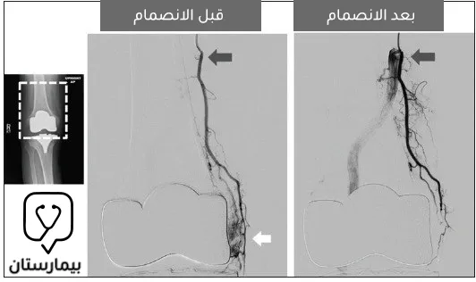 صورة ظليلة تظهر شرايين الركبة قبل الانصمام وبعده