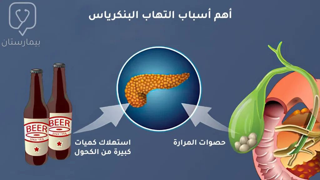 أهم أسباب ظهور أعراض  التهاب البنكرياس والتي تتمثل بحصوات المرارة والإفراط في استهلاك الكحول