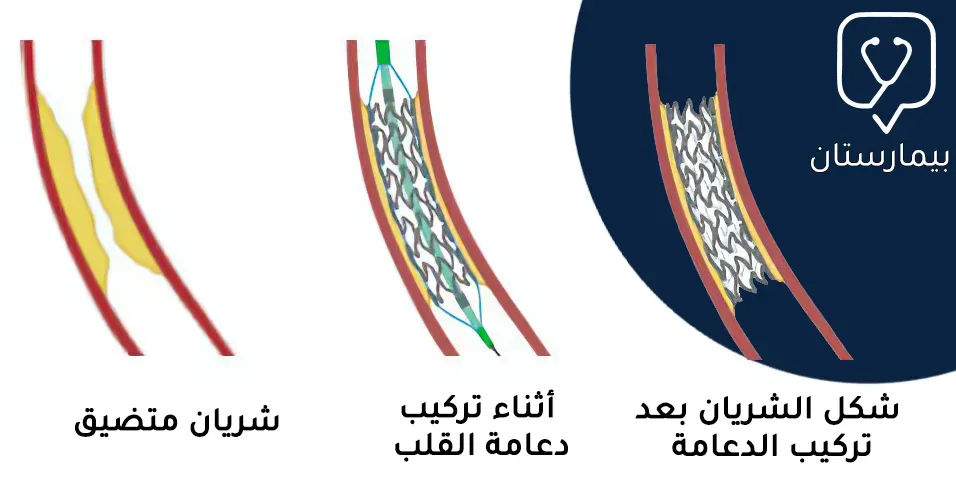 شكل دعامة القلب التي تم تركيبها لتوسيع الشريان المتضيق