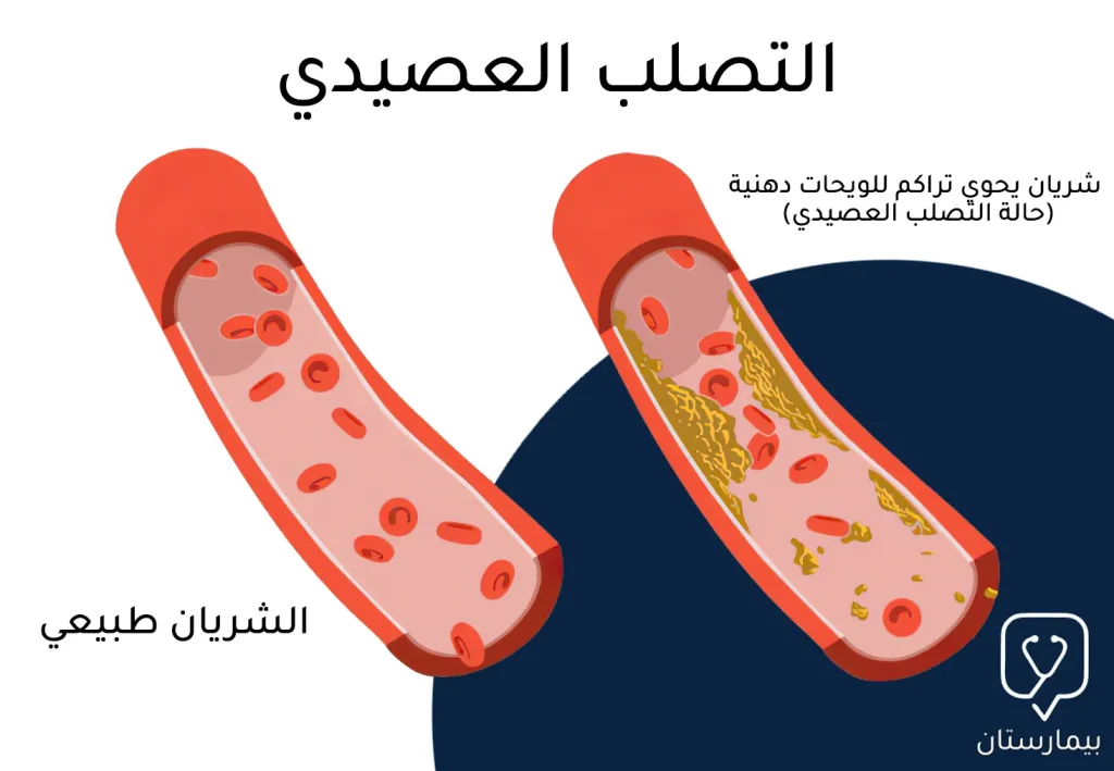 توضح هذه الصورة حالة التصلب العصيدي التي تتظاهر بتضيق الشريان نتيجة تراكم اللويحات الدهنية حول جدار الوعاء مما يستدعي تركيب دعامة القلب لتوسيعه