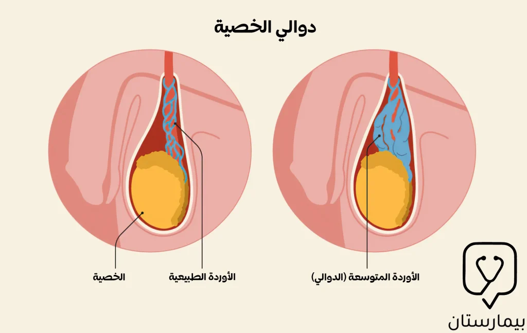 توضح هذه الصورة مقارنة بين حالة التوسعات الوريدية (الدوالي) والتي قد تحاج لإجراء عملية دوالي الخصية وبين الحالة الطبيعية لأوردة الخصيتين