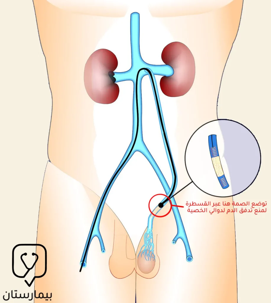 تظهر هذه الصورة كيفية القيام بعملية دوالي الخصية عن طريق تصميم الأوردة بالقسطرة