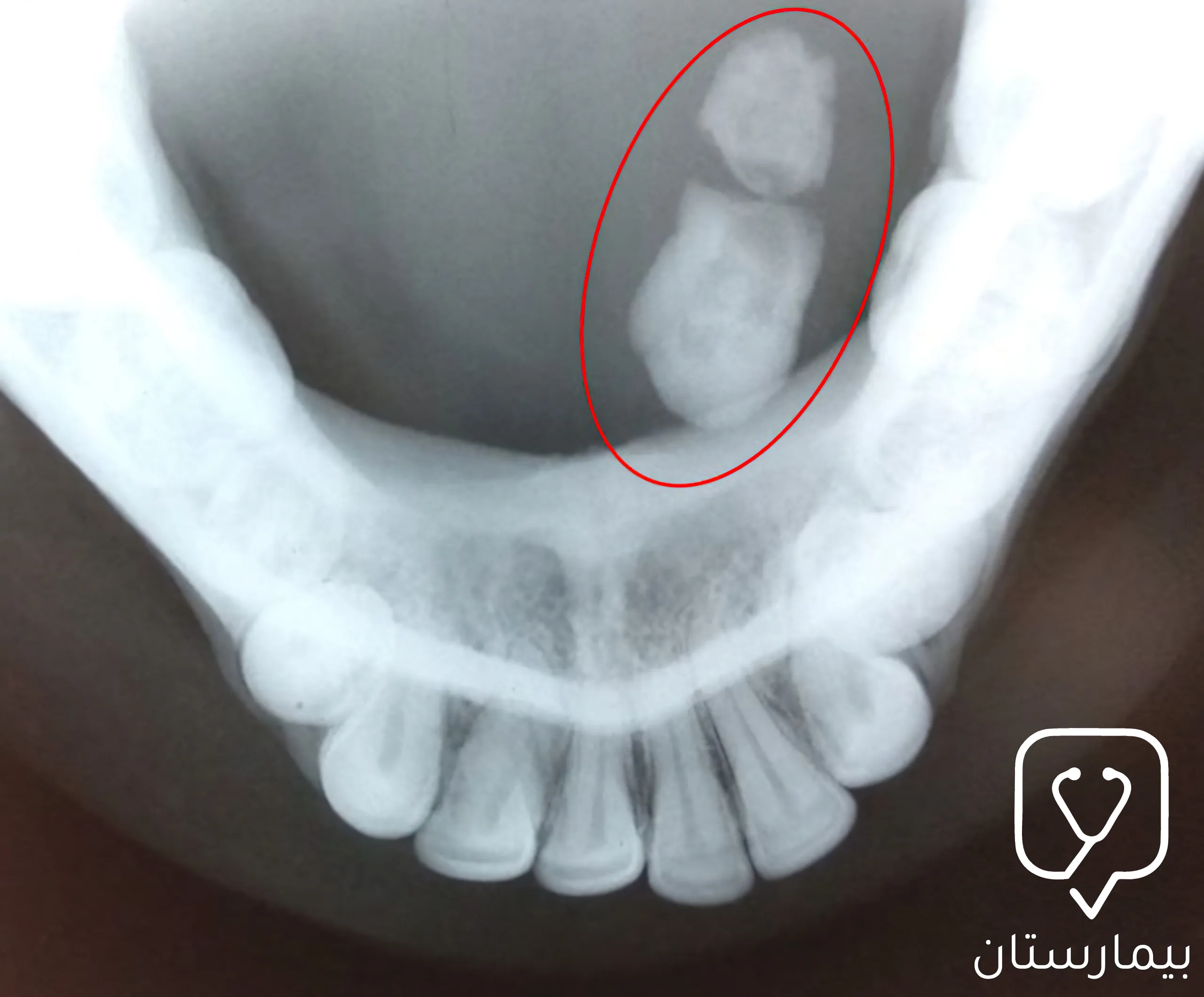 تشير الدائرة ضمن هذه الصورة الشعاعية لمنطقة وجود الحصوة اللعابية