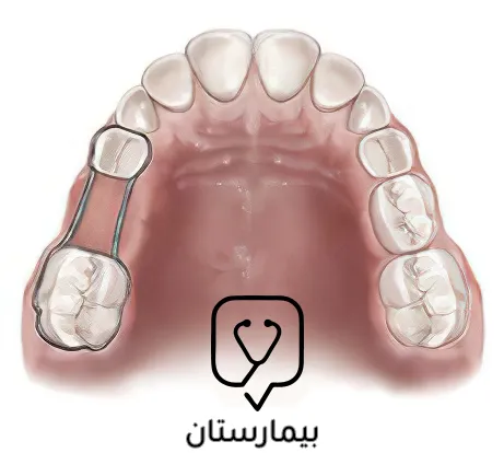 حافظ مسافة أحادي الجانب