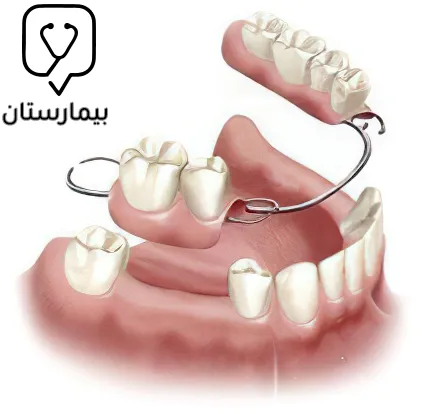 حافظة مسافة قابلة للإزالة