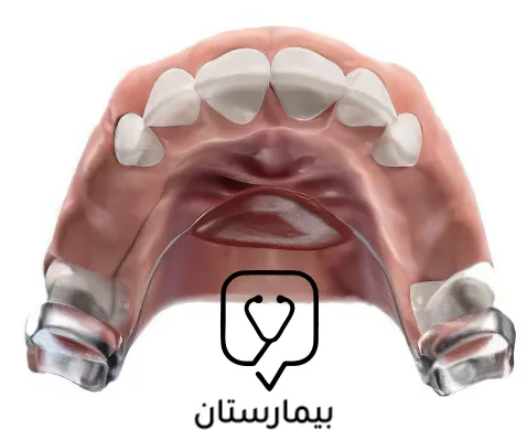 حافظة مسافة ثنائة الجانب تكون على كلا طرفي الفك