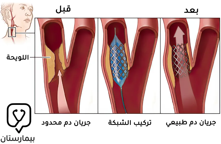 صورة توضح جريان الدم عبر الشريان السباتي قبل وبعد إجراء رأب الشريان السباتي وتركيب دعامة