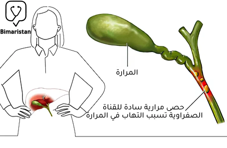 نلاحظ في هذه الصورة وجود حصوة مرارية تسد مجرى القناة الصفراوية وبالتالي تظهر أعراض المرارة عند النساء