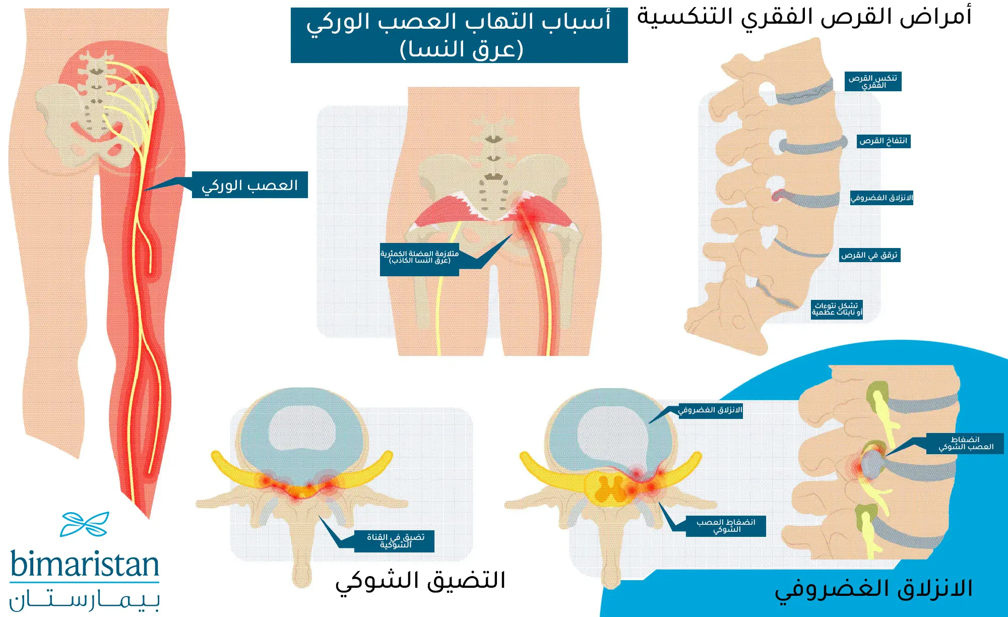 اسباب التهاب العصب الوركي والحالات العصبية والعظمية المسببة له