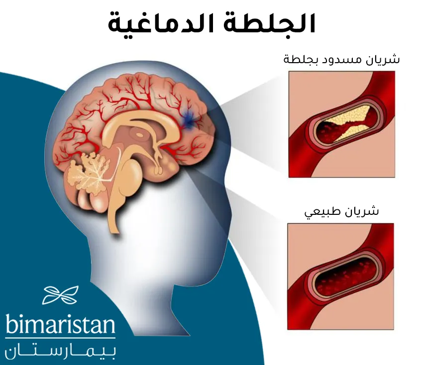 توضح هذه الصورة انسداد شريان دماغي بسبب جلطة المخ عند كبار السن