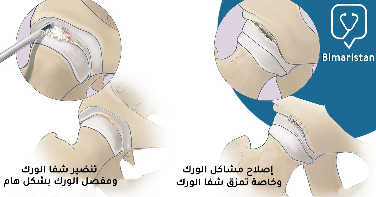 توضح الصورة ما يمكن إصلاحه خلال عملية منظار الورك