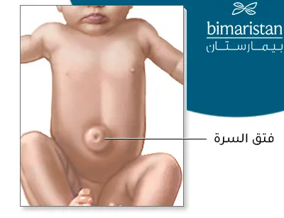 صورة توضح شكل الفتق السري عند الأطفال على شكل انتفاخ مكان سرة الطفل