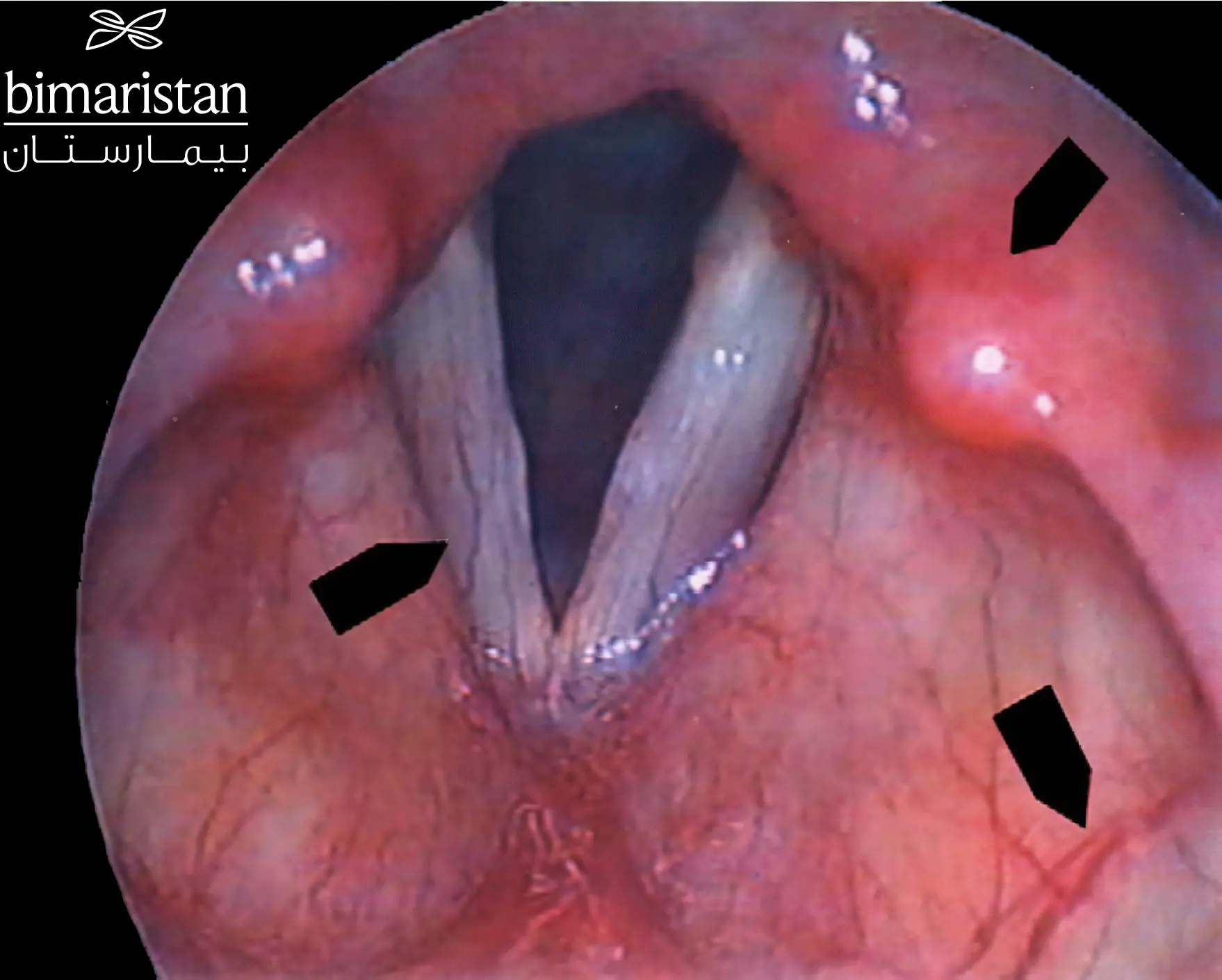 صورة تنظير الحنجرة توضح التهاب الحبال الصوتية