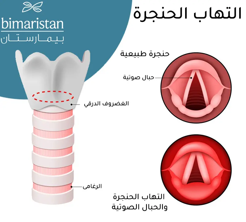 صورة ترسيمية توضح الفرق بين الحنجرة الطبيعية والحنجرة الملتهبة