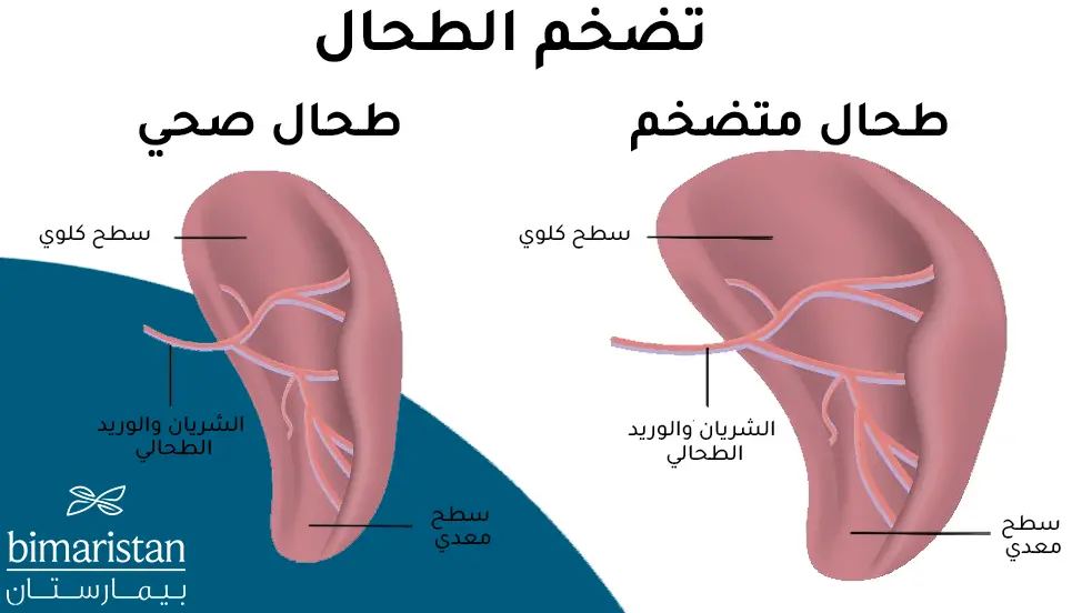 صورة ترسيمية توضح الفرق بين الطحال الطبيعي والطحال المتضخم