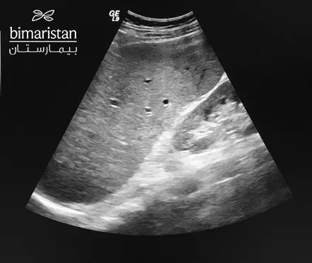 صورة إيكو توضح وجود تضخم في االطحال عند طفل