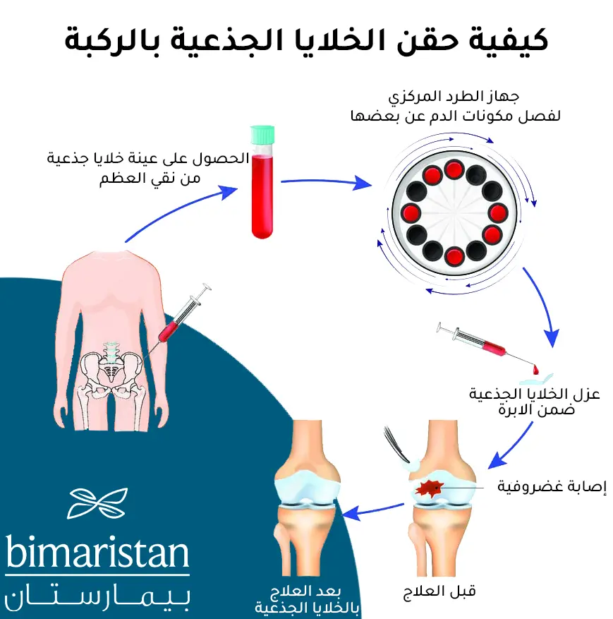 صورة توضح كيفية حقن البلازما للركبة