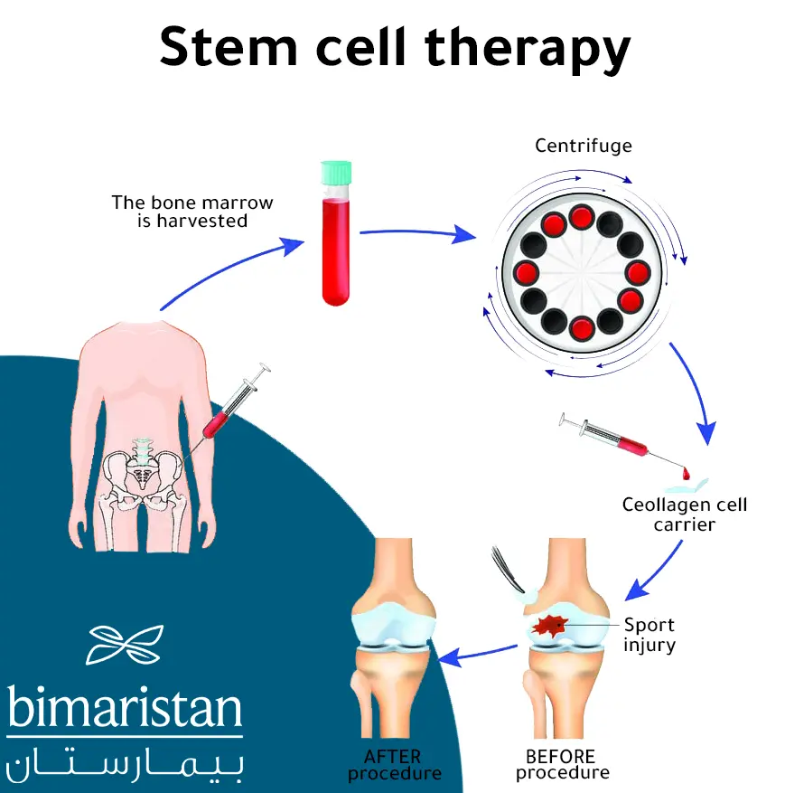 An Image Illustrating How Prp Is Injected Into The Knee
