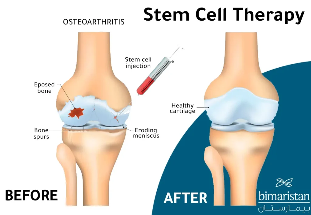 An Illustration Comparing The Condition Of The Joint Before Stem Cells Injection For Knee And After A Period Following The Injection.