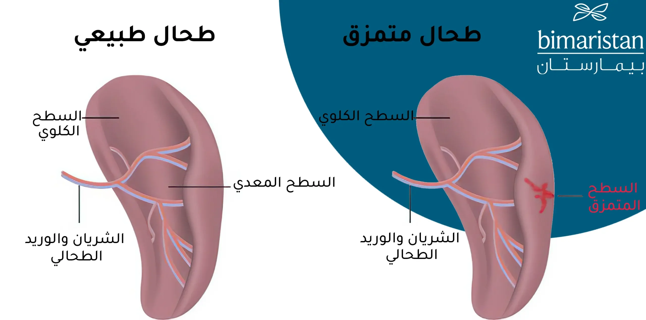 صورة توضح الفرق بين الطحال الطبيعي والطحال المتمزق