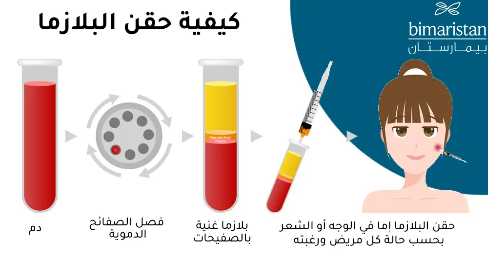 صورة توضح كيفية حقن البلازما للشعر والوجه 