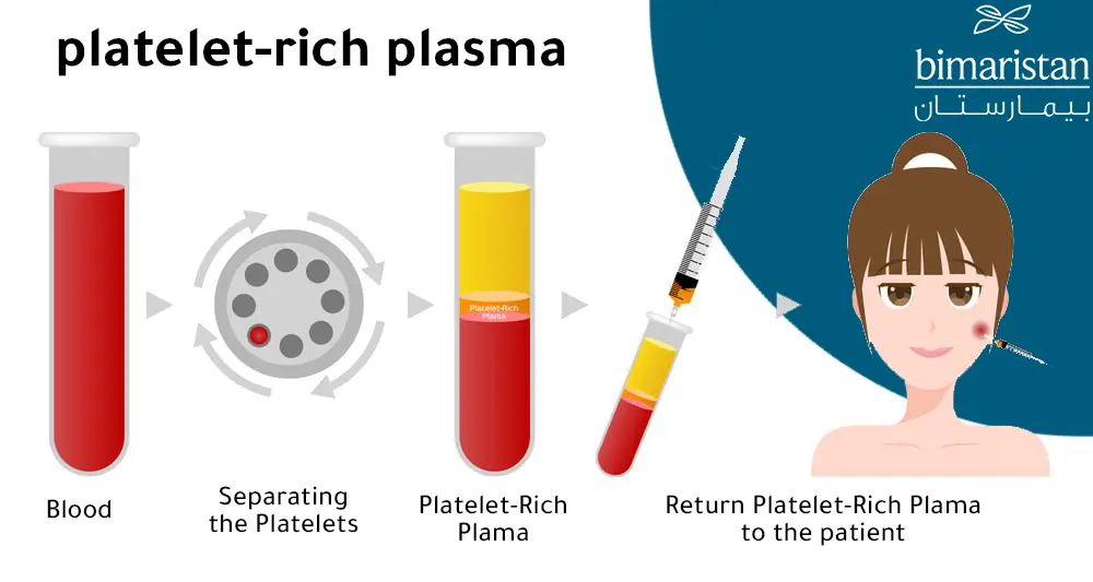 A Picture Illustrating How Plasma Is Injected For Hair And Face