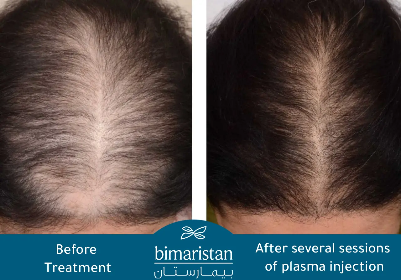 Before And After Prp For Hair And Face In Turkey