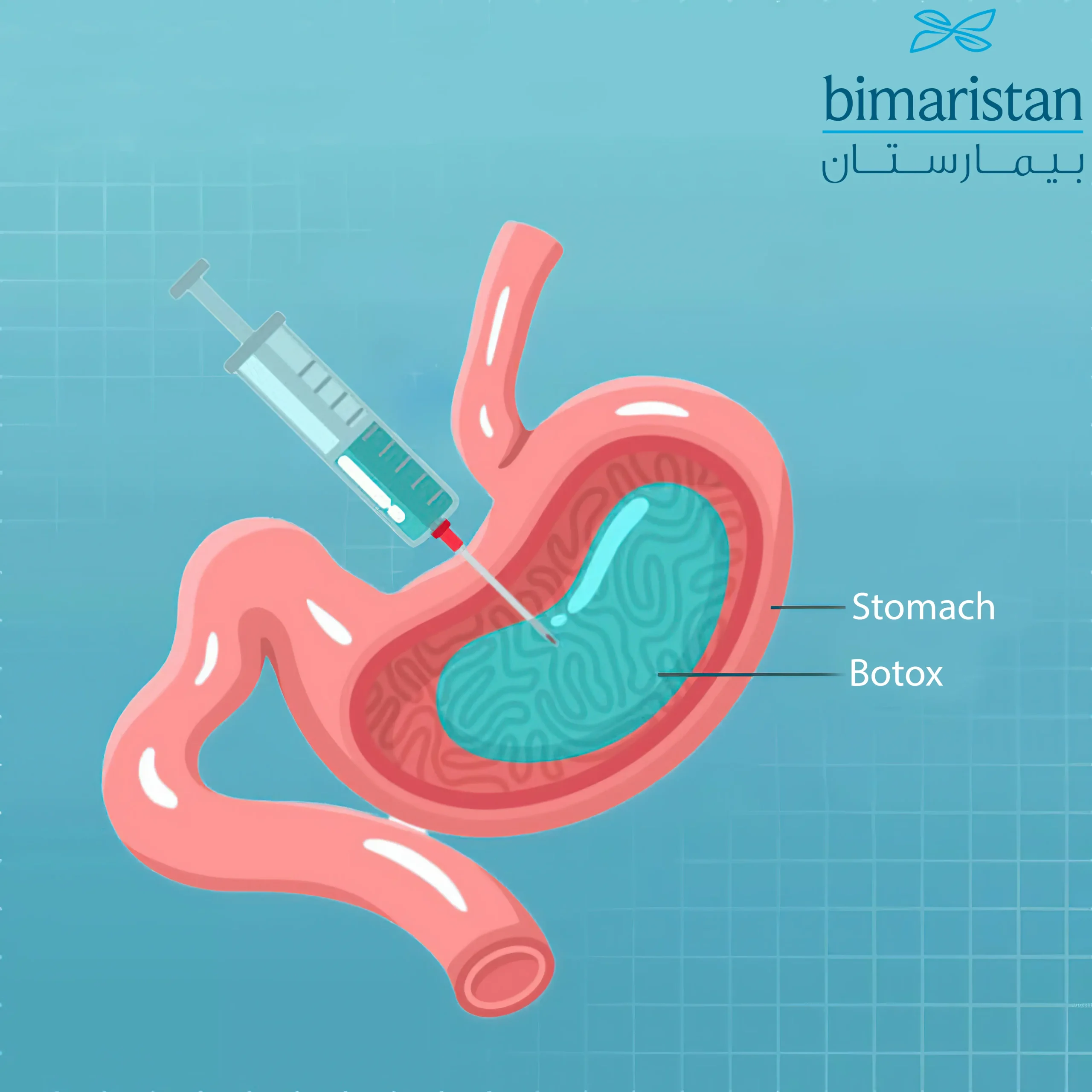 Gastric Botox Injections In Turkey Require Some Time For The Results To Become Clear