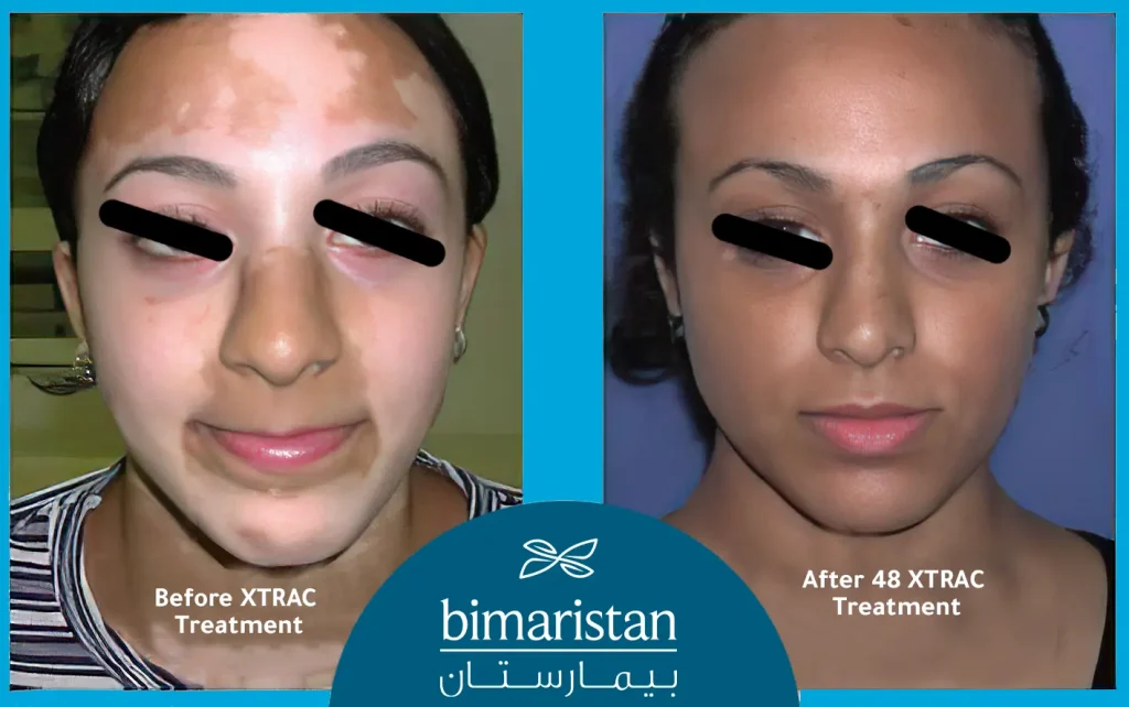 Before And After Laser Treatment For Vitiligo