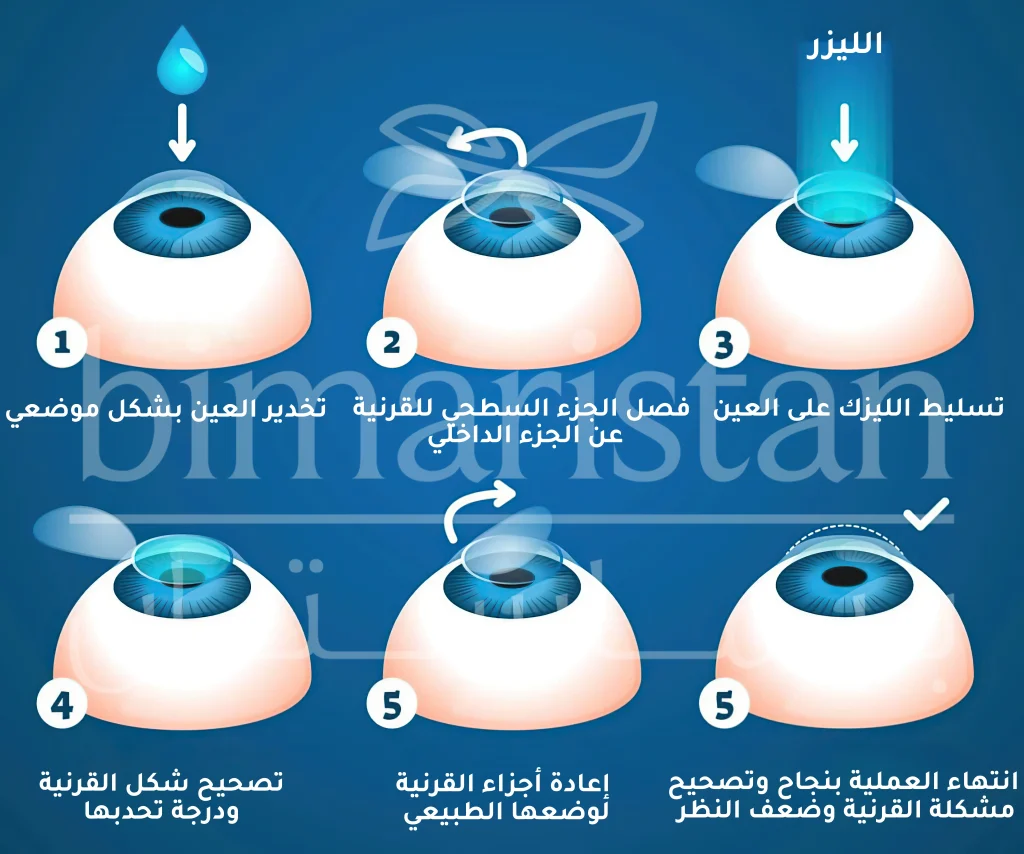 خطوات إجراء عملية الليزك في تركيا