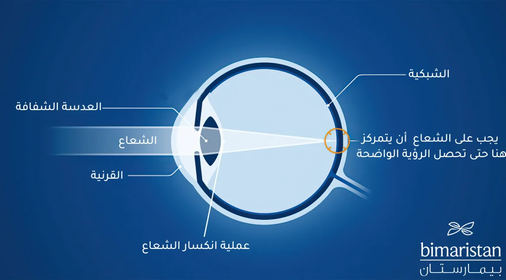 توضح هذه الصورة عملية الرؤية الطبيعية وكيفية دخول الشعاع وانكساره حتى يقع الظل على الشبكية تماماً وإن عملية الليزك في تركيا تهدف لتصحيح أخطاء انكسار هذا الشعاع لإعطاء الرؤية الواضحة والصافية