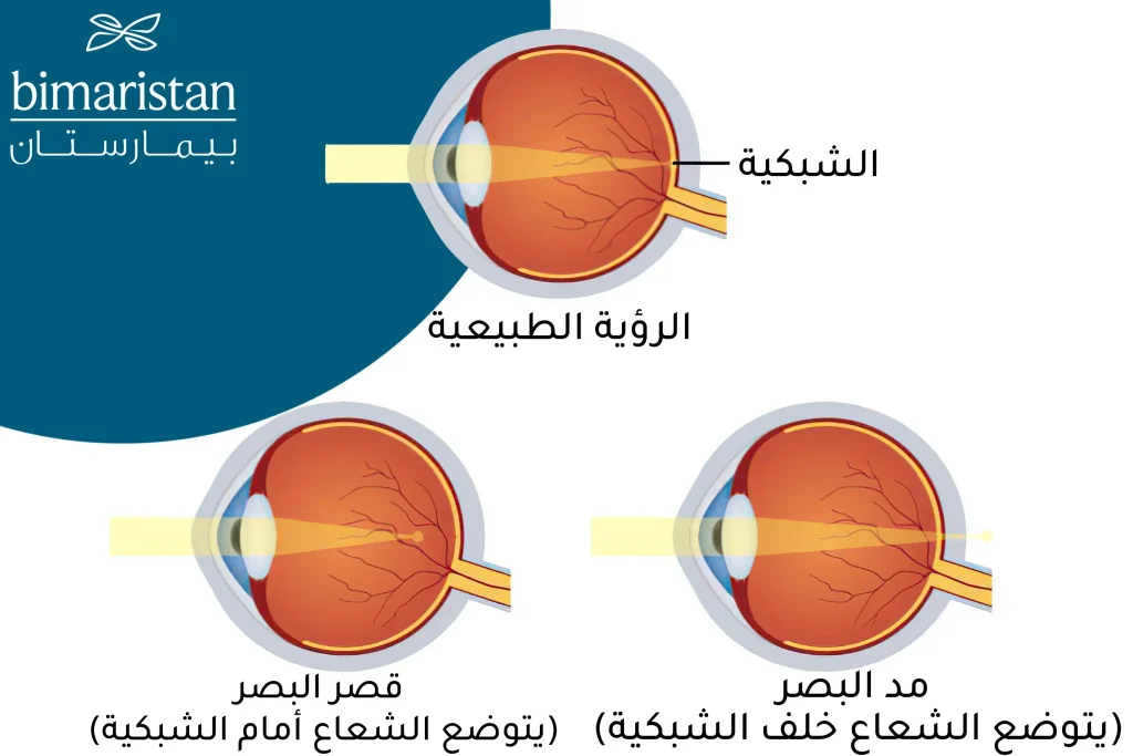 عيوب البصر التي يمكن تصحيحها من خلال عملية الليزك في تركيا