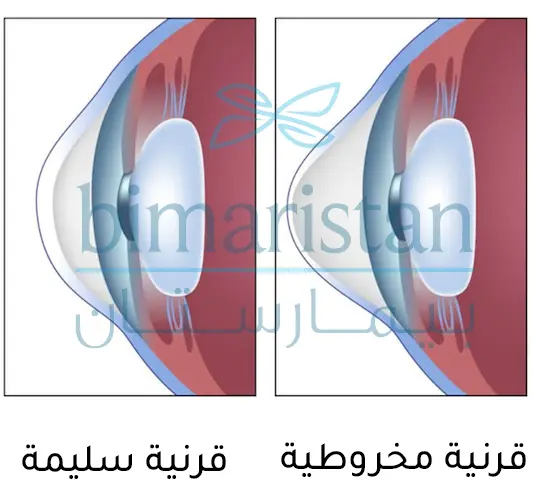 صورة ترسيمية توضح الفرق في الشكل بين القرنية السليمة والقرنية المخروطية