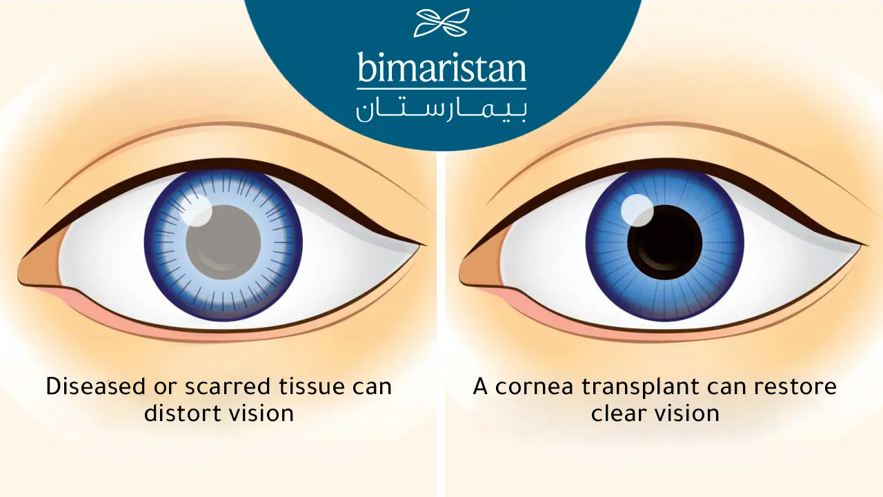 The Difference Between A Diseased Cornea And A Healthy Cornea And Their Impact On Vision