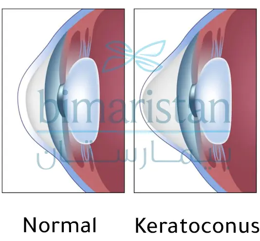 The Difference Between A Healthy Cornea And A Keratoconus In Terms Of Shape (Keratoconus Corneal Transplantation).