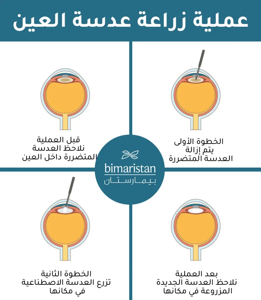 خطوات عملية زراعة عدسة العين في تركيا