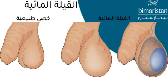 صورة توضح الفرق بين الصفن الطبيعي والصفن المتورم بسبب القيلة المائية حول الخصية