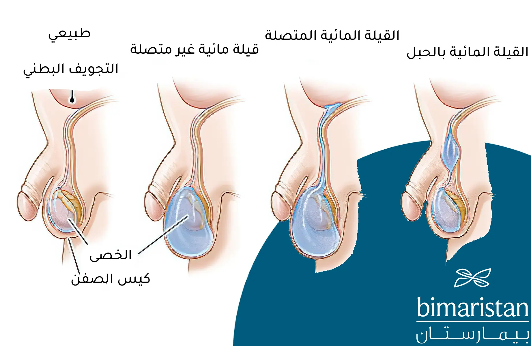 صورة لأنواع القيلة المائية