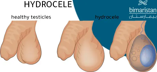 We Notice The Shape Of The Hydrocele Around The Testicle, Which Causes Swelling Of The Scrotum Compared To The Normal Shape Of The Scrotum