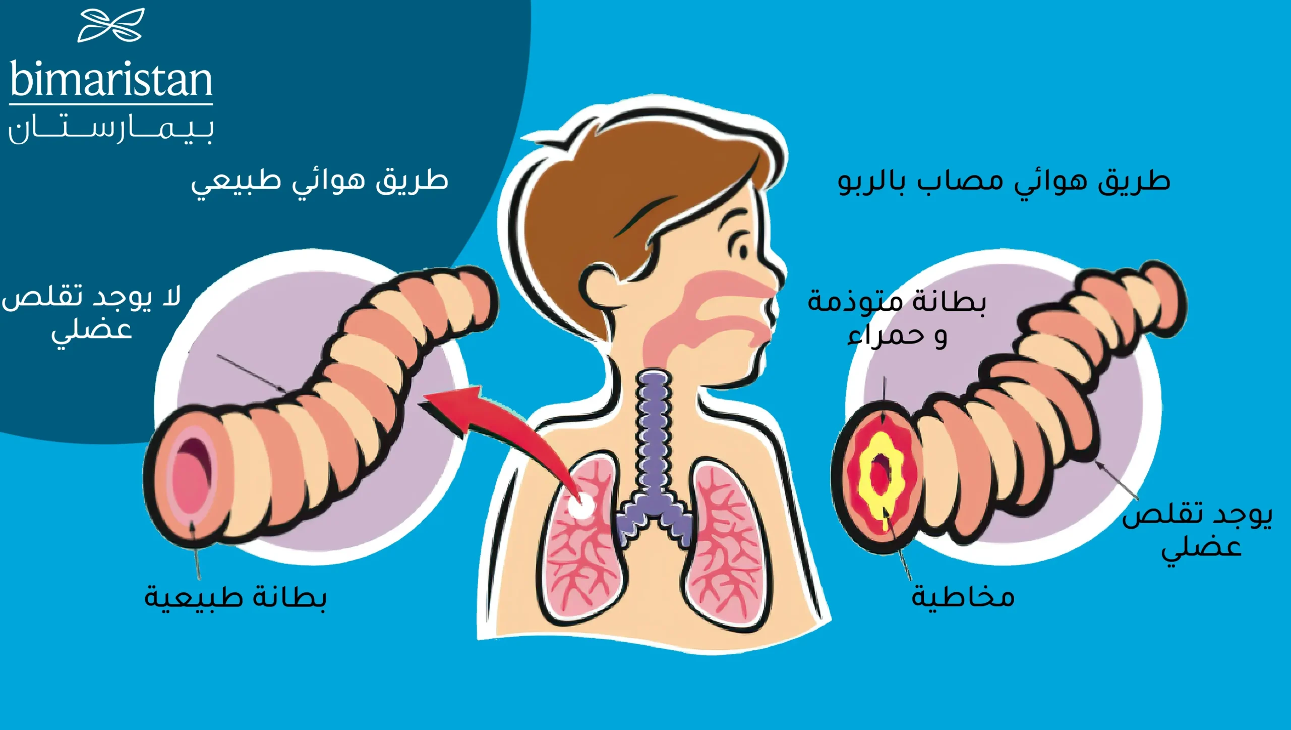 صورة ترسيمية توضح الفرق بين الطرق الهوائية الطبيعية والطرق الهوائية المصابة بالربو